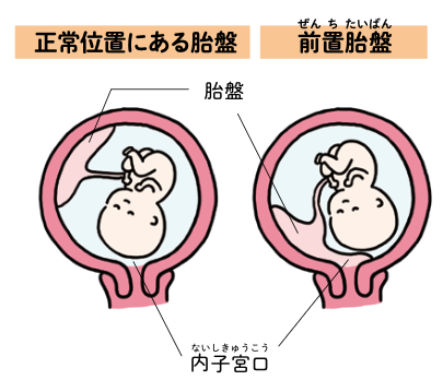 胎盤と内子宮口