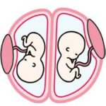 二絨毛膜二羊膜双胎