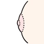 扁平乳頭