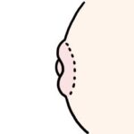 陥没乳頭