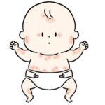 赤ちゃんのアレルギー